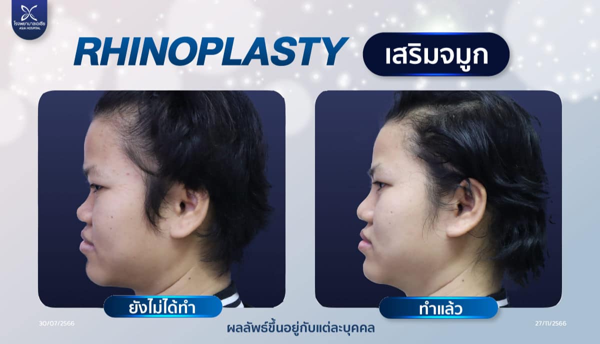 ศัลยกรรมเสริมจมูก