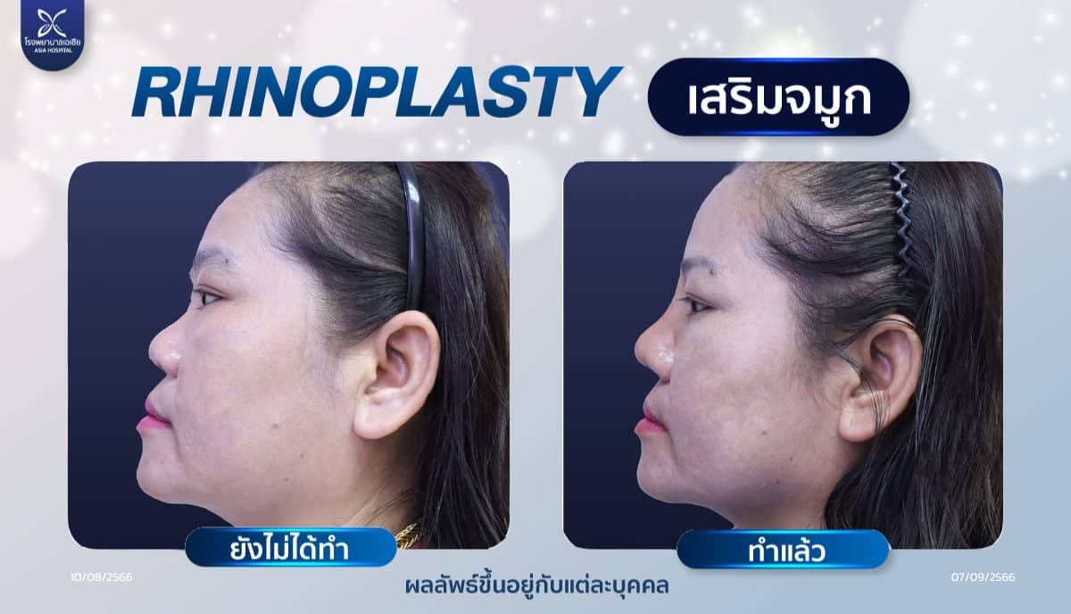 ศัลยกรรมเสริมจมูกแต่งปลาย