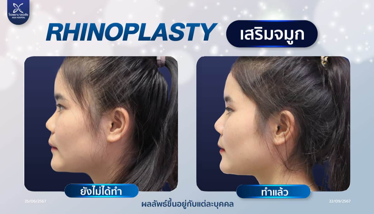 เสริมจมูก-rhinoplasty