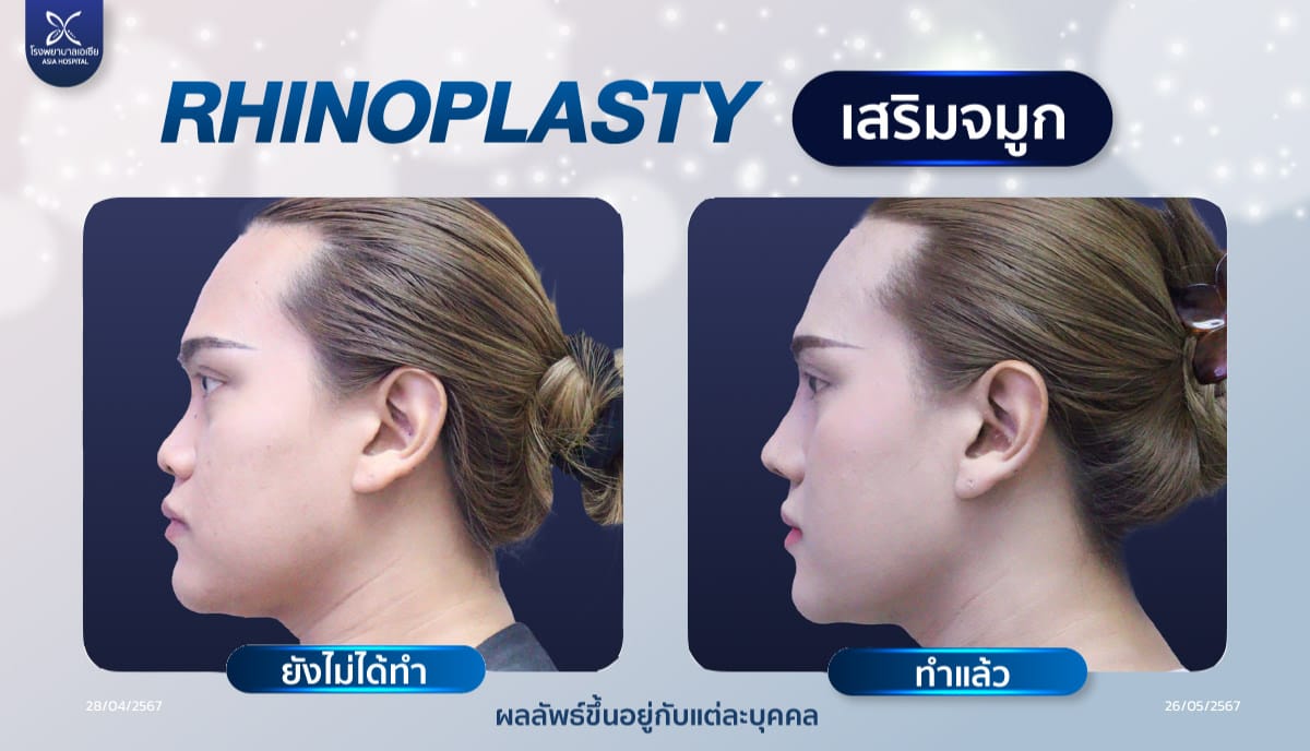เสริมจมูก-แต่งปลาย