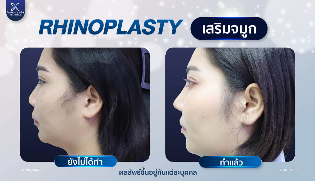 เสริมจมูก