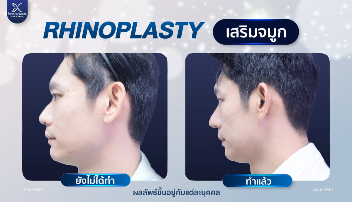 เสริมจมูก_แต่งปลายจมูก
