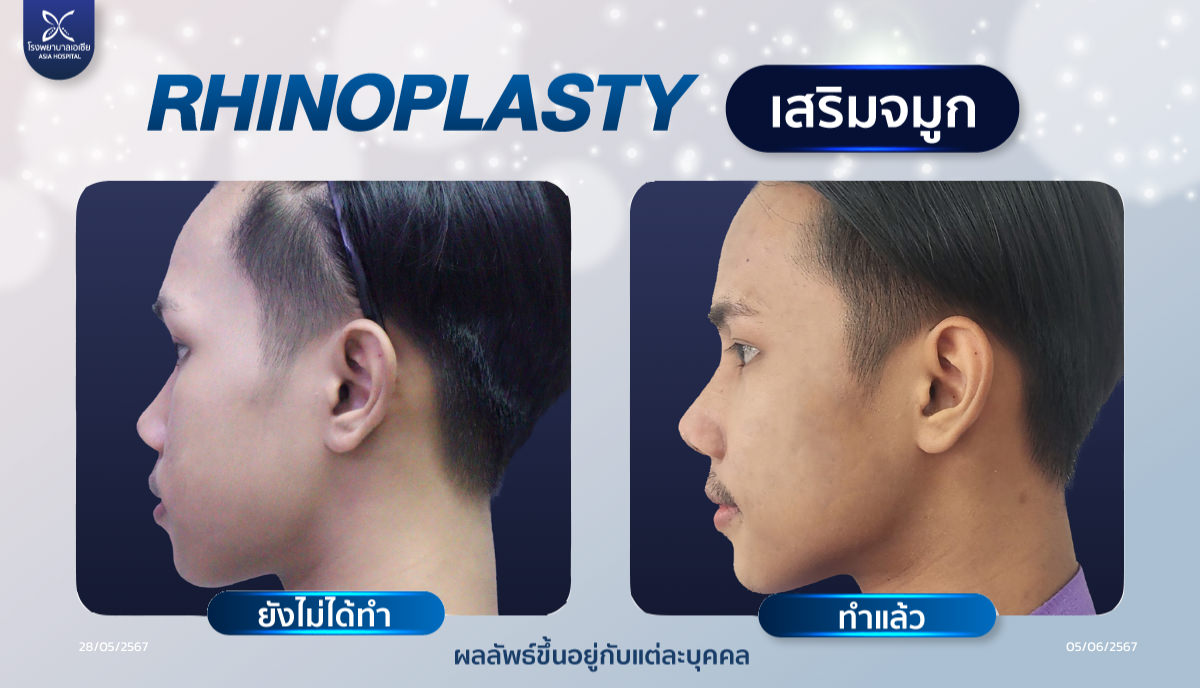 เสริมจมูกผู้ชาย แต่งปลาย