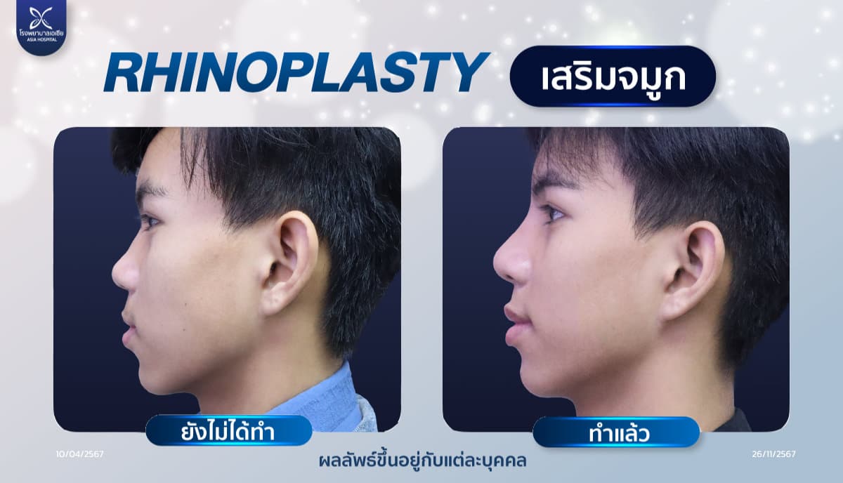 เสริมจมูกแต่งปลาย