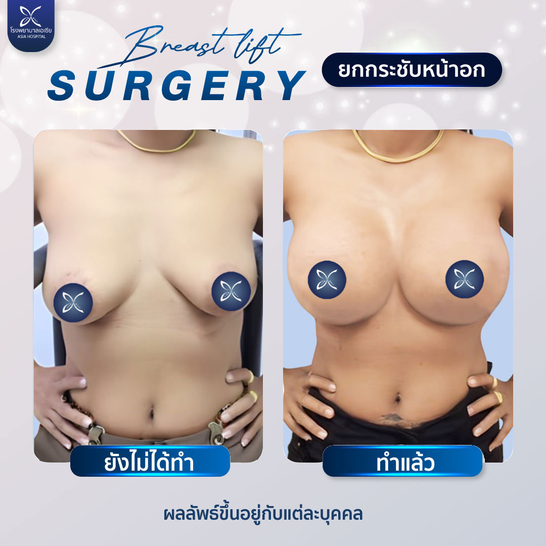 แก้หน้าอก ยกกระชับ