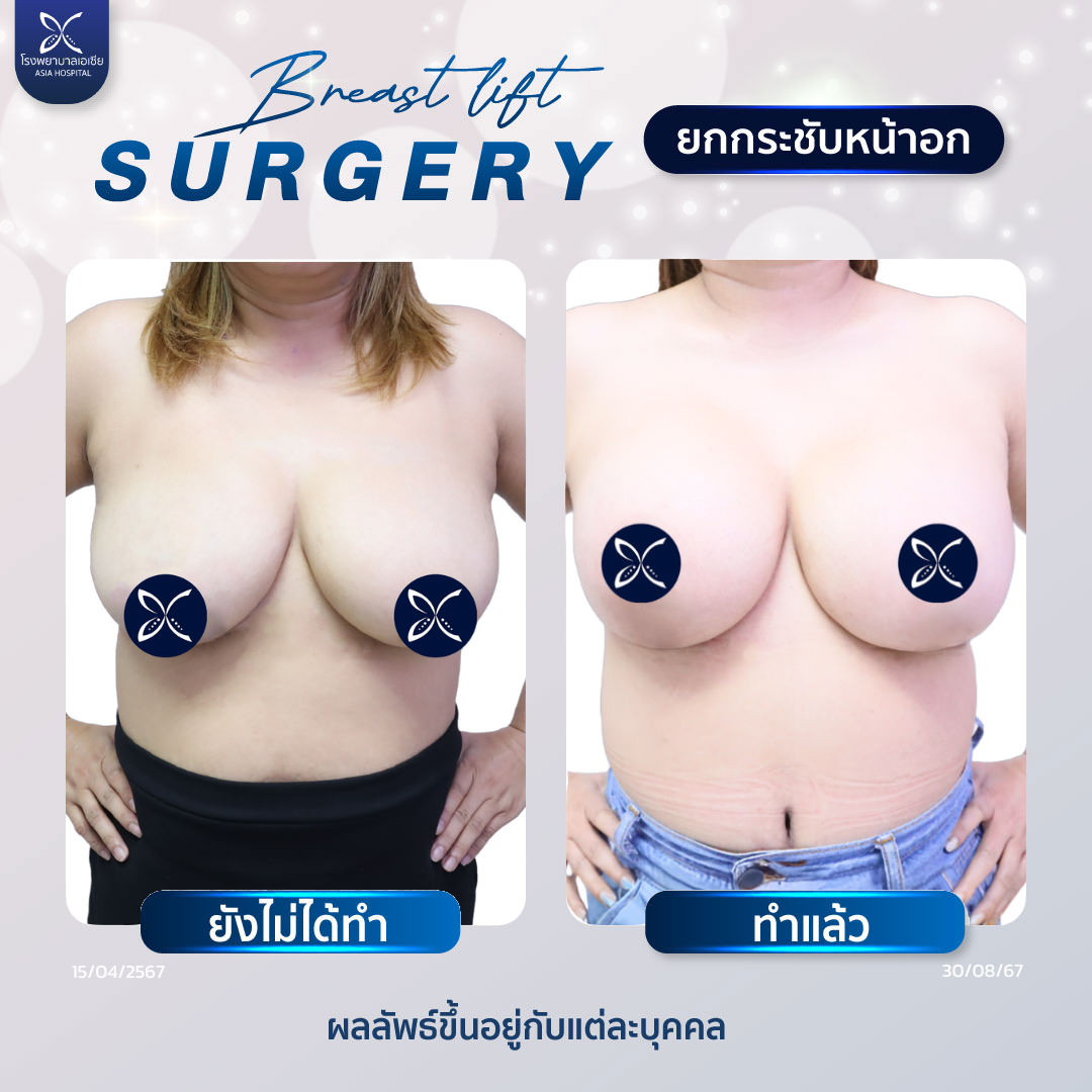 แก้หน้าอก ยกกระชับหน้าอก